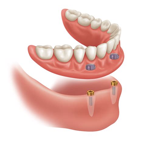 locator implant attachment system